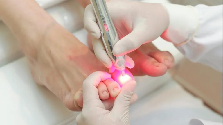 Mycoses cutanées : Traitement par laser dermatologique